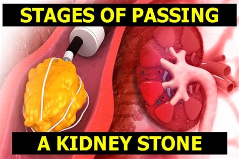 Should I Go to ER for Kidney Stone: A Journey Through Pain, Panic, and Peculiar Decisions