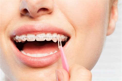 Why Do You Wear Rubber Bands with Braces? And Why Do They Taste Like Regret?